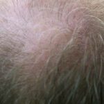Diradamento capelli e tipologie di alopecia: come fare?
